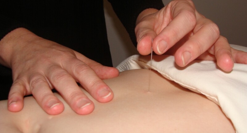 Needling Abdoman during acupuncture treatment