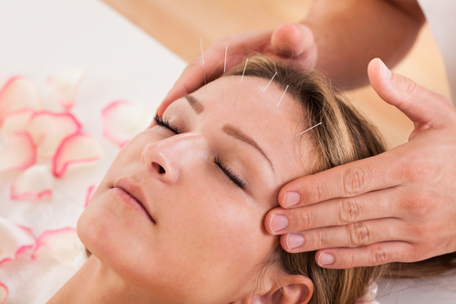 Woman undergoing acupuncture treatment with a line of fine needles inserted into the skin of her forehead