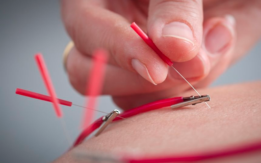 Electro-Acupuncture